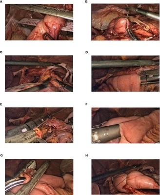 Application of λ esophagojejunostomy in total gastrectomy under laparoscopy: a modified technique for post-gastrectomy reconstruction